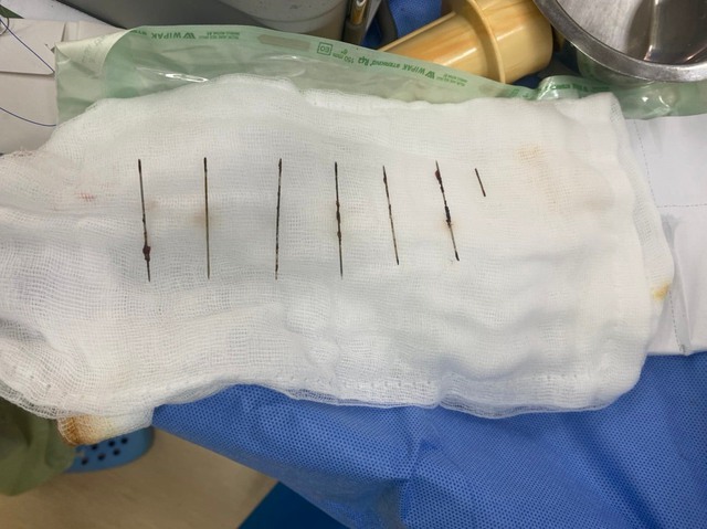 Gắp 7 cây kim trong lồng ngực nữ bệnh nhân nhiễm HIV - Ảnh 1. Gắp 7 cây kim trong lồng ngực nữ bệnh nhân nhiễm HIV - Ảnh 1.