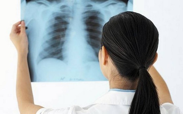 Phát hiện sớm bệnh lao phổi để tránh biến chứng nguy hiểm - Ảnh 1.