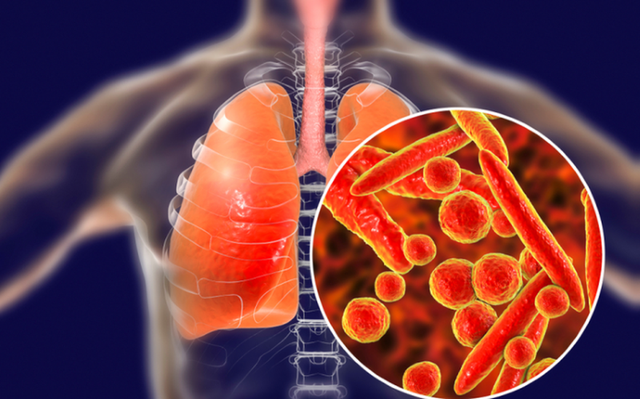 Giảm nguy cơ tái phát lao ở người nhiễm HIV: Vai trò của điều trị và chăm sóc toàn diện- Ảnh 1. Giảm nguy cơ tái phát lao ở người nhiễm HIV: Vai trò của điều trị và chăm sóc toàn diện- Ảnh 1.