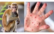 Tăng cường giám sát đậu mùa khỉ tại cơ sở khám bệnh HIV/AIDS