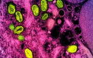 WHO: Người nhiễm HIV nên xét nghiệm phát hiện sớm bệnh đậu mùa khỉ
