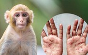 Ghi nhận thêm trường hợp mắc bệnh đậu mùa khỉ tại Đồng Nai