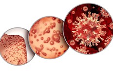 63% ca bệnh đậu mùa khỉ chủ yếu là nam giới đang nhiễm HIV