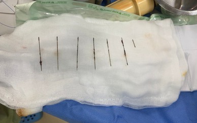 Gắp 7 cây kim trong lồng ngực nữ bệnh nhân nhiễm HIV