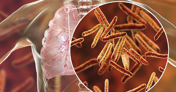 Vi khuẩn lao từ nguồn nào lây vào phổi?

