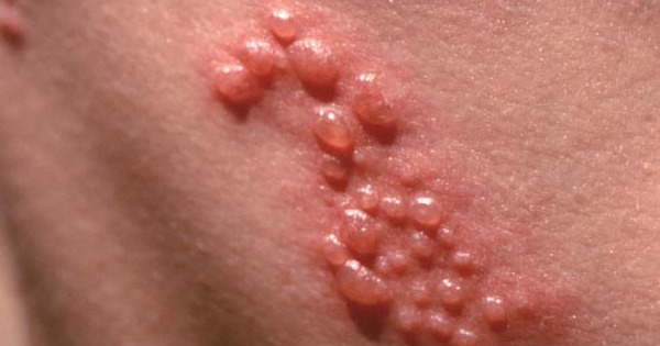 Virus Herpes simplex và mụn rộp da có liên quan gì đến mụn rộp hiv?
