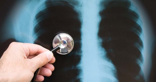 Nguyên nhân gây ra bệnh hạch lao phổi là gì?
