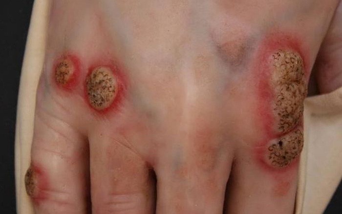Triệu chứng thường gặp của bệnh lao da